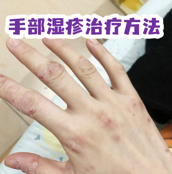 湿疹疗法I期数据公布 Corvus股价大幅下挫